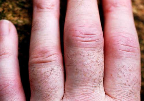 Rheumatoid Arthritis Fingers