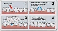 Affixing Dental Bridges