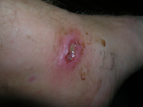 A severe wound from coral infection