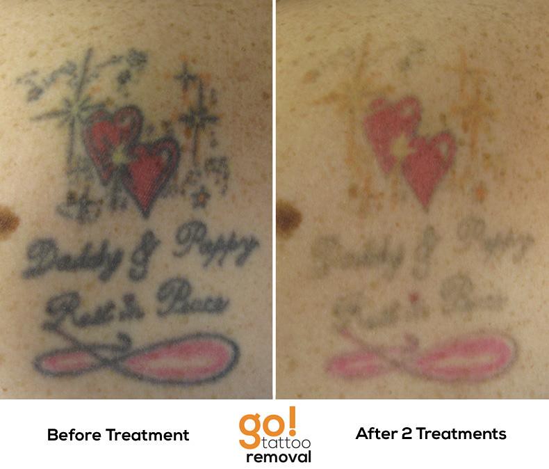 Laser Tattoo Removal Progress Photos | Allentown, PA