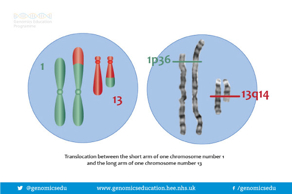 Translocation on chromosome 1 and chromosome 13