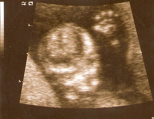 ultrasound week 12