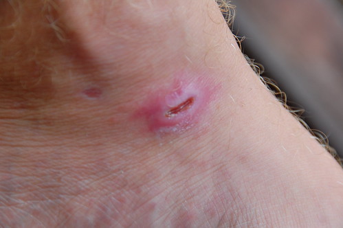 A severe travel injury from marine bacteria