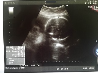 妊娠７ヵ月エコー写真 赤ちゃん