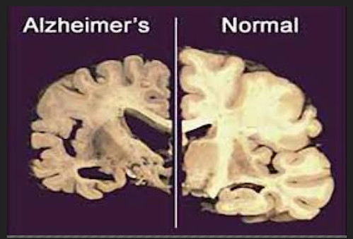 Autosomal-dominant Alzheimer’s affects families with a genetic mutation, predisposing them to the crippling disease. These families provide crucial insight into the development of Alzheimer’s because they can be identified years before symptoms develop. This image shows a normal brain slice and a brain slice of an Alzheimer's patient. Adapted from the University of Melbourne article.