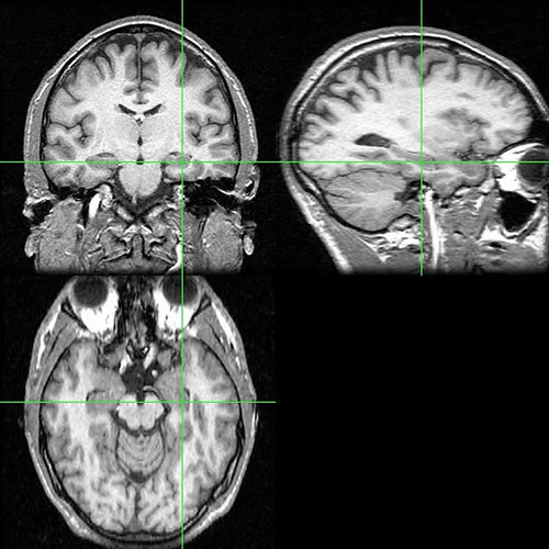 This MRI scan shows the location of the hippocampus.