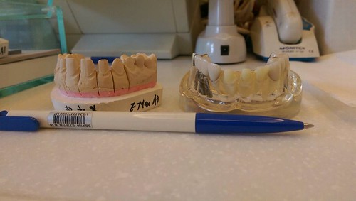 台中豐美牙醫假牙諮詢心得 假牙修磨你可以有更好的選擇 (7)