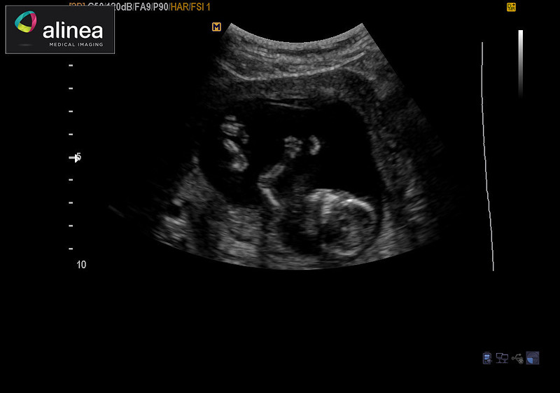 littler love at 13 weeks and 3 days