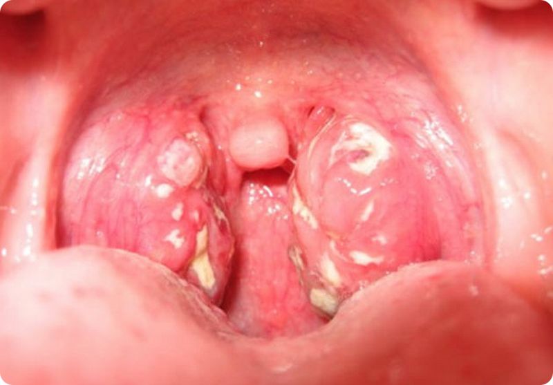 Tonsilitis Throat 32