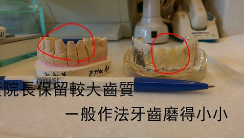 台中豐美牙醫假牙諮詢心得 假牙修磨你可以有更好的選擇 (8) - 醫師為患者保留最多齒質