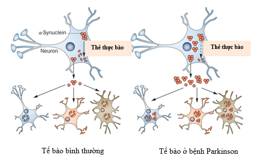 Alpha – synuclein trong các tế bào neuron ở bệnh nhân Parkinson