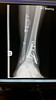 22-01-2015 x-ray of right leg from front