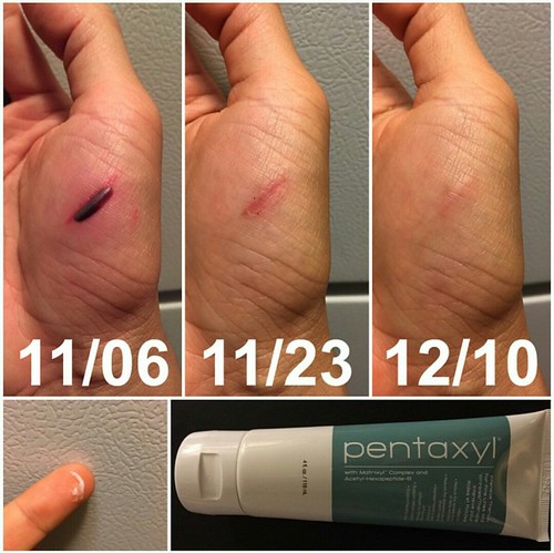  Before and after results of Pentaxyl - blood blister