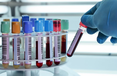 Xét nghiệm máu giúp chẩn đoám sớm bệnh Parkinson (7)