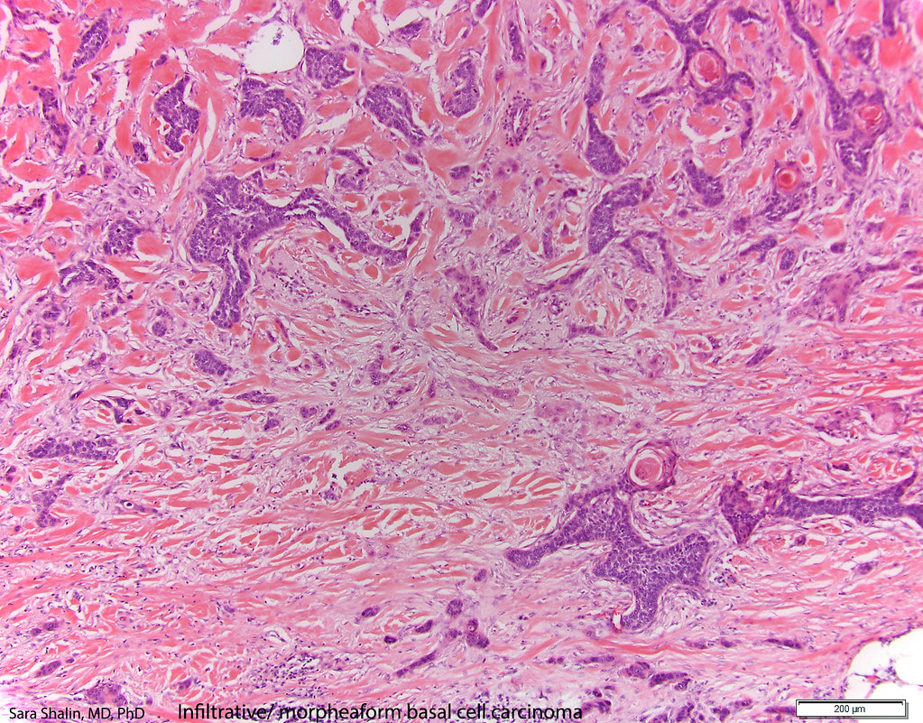 Pathology Outlines Basal Cell Carcinoma