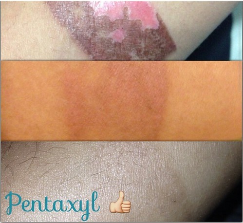  Before and after results of Pentaxyl - burn