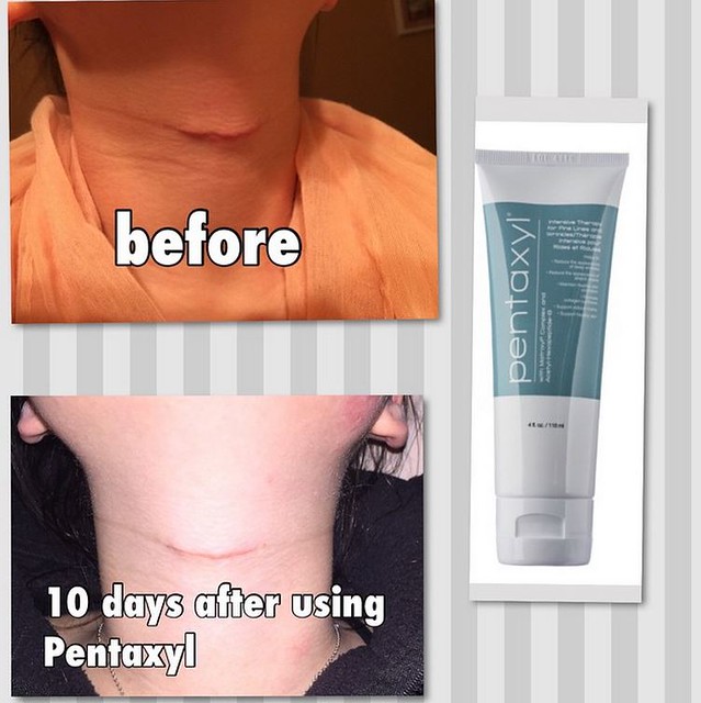  Before and after results of Pentaxyl - scar